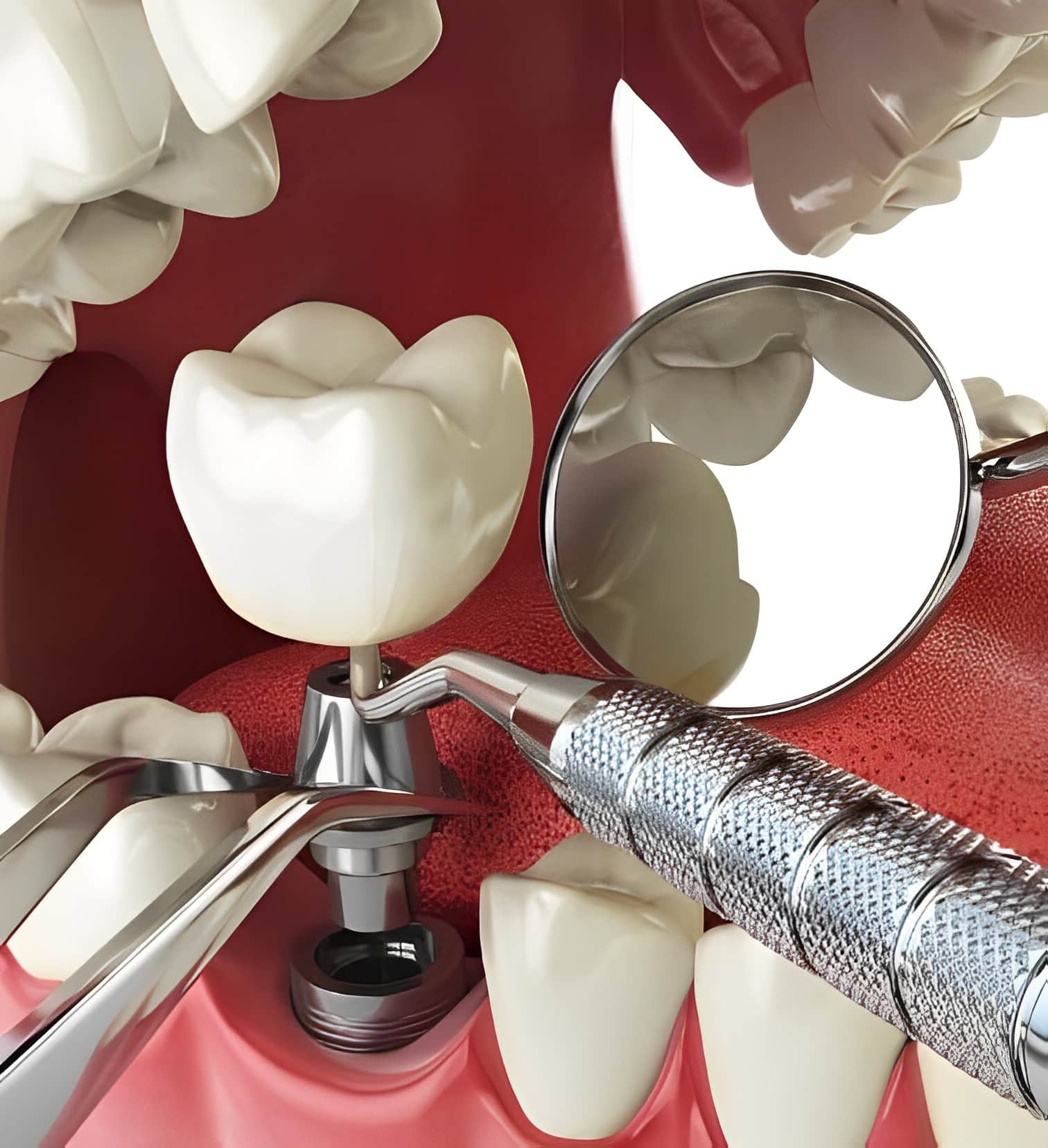 Dental Implants in Phoenix