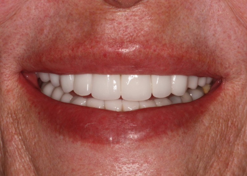 Smiling after getting porcelain veneers in Phoenix